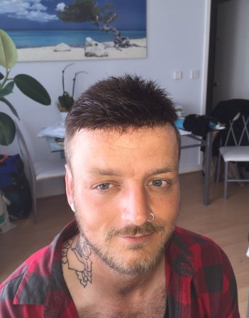 Hair loss treatment and non-surgical hair replacement for men at Sofia's Crown in London – expert solutions for male hair loss and thinning hair.