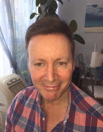 Hair Replacement For Men United Kingdom