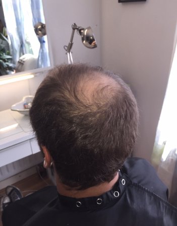 Men’s hair replacement London
