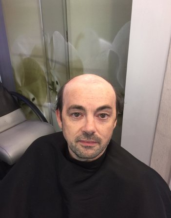 Hair Loss Treatment London
