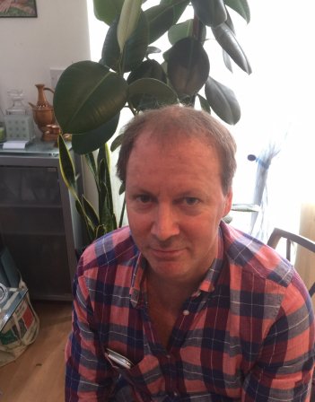 Male Hair Loss Treatment London