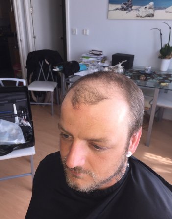 Man receiving non-surgical hair replacement treatment at Sofia's Crown clinic in London, specializing in solutions for hair loss treatment and men's hair replacement.