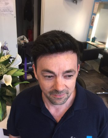 Hair Replacement For Men London