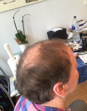 crown bald spot London