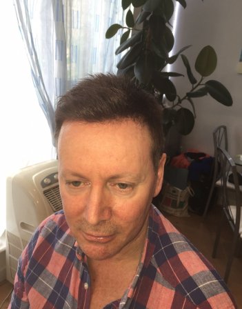 Male Hair Loss Clinics London